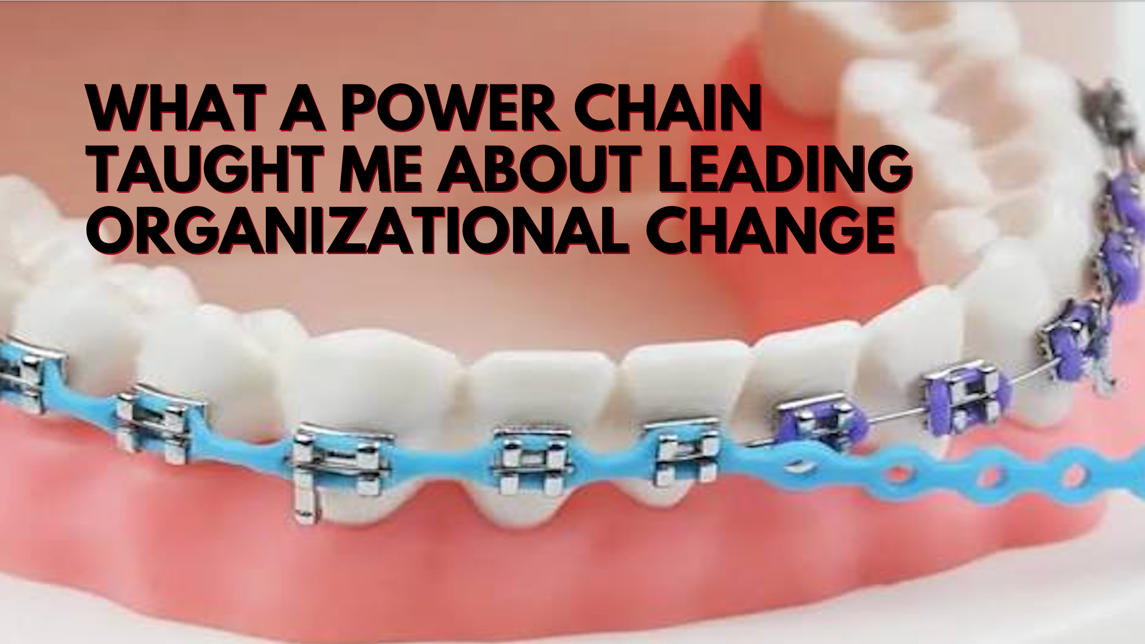 Orthodontic power chain demonstrating how connected pressure moves multiple teeth, illustrating organizational change leadership.