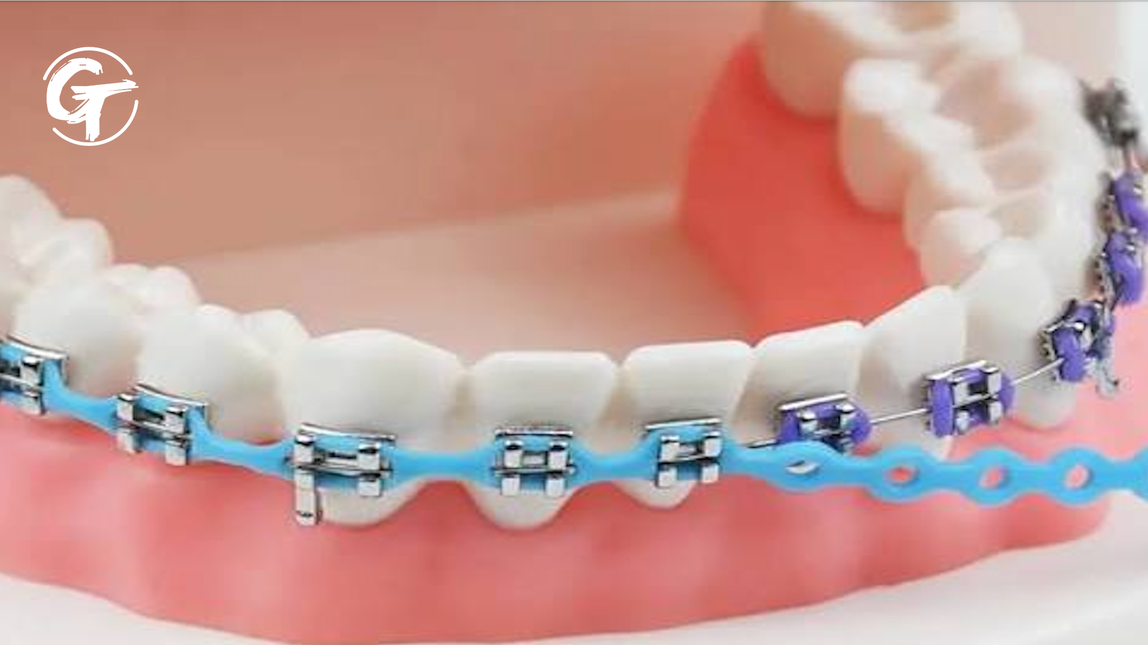 Orthodontic power chain demonstrating how connected pressure moves multiple teeth, illustrating organizational change leadership.